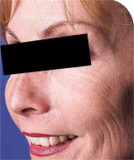 Kr&auml;henf&uuml;&szlig;e nach der Behandlung mit Botox
